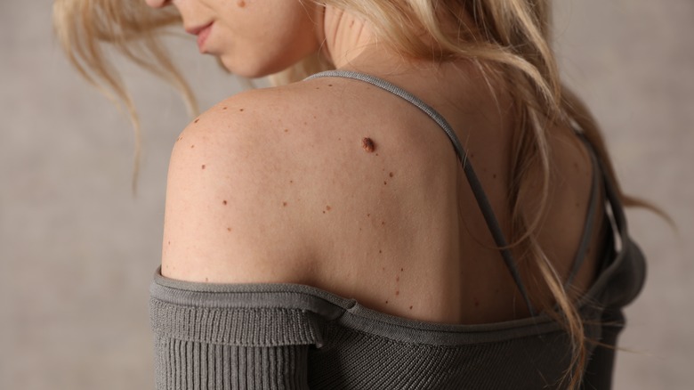 Woman with skin tag