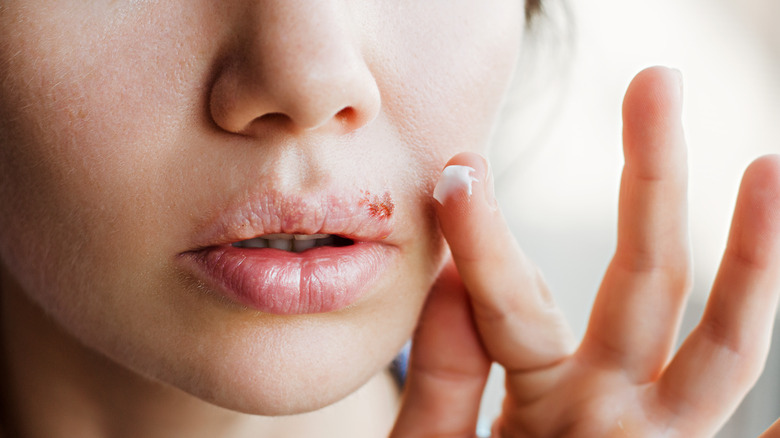 Close up of cold sore on woman's lip