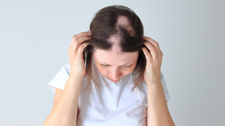 women showing her patchy hair loss 