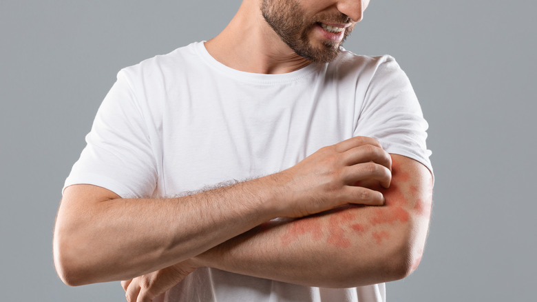 bearded man with eczema on arm
