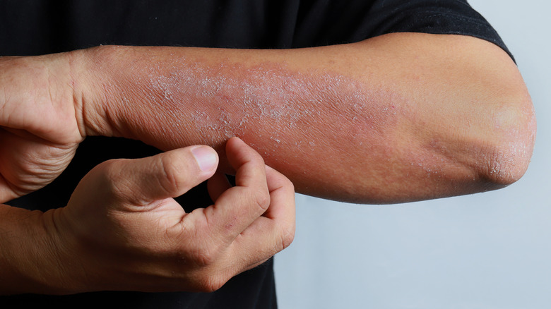 man scratching eczema