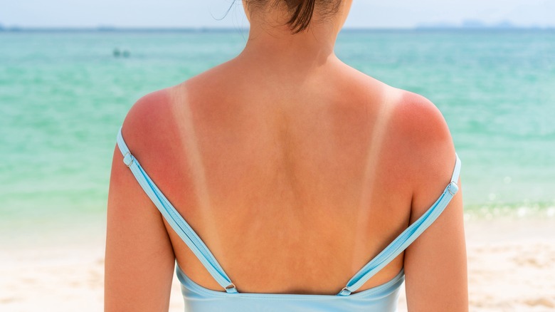 Girl with sunburn on shoulders