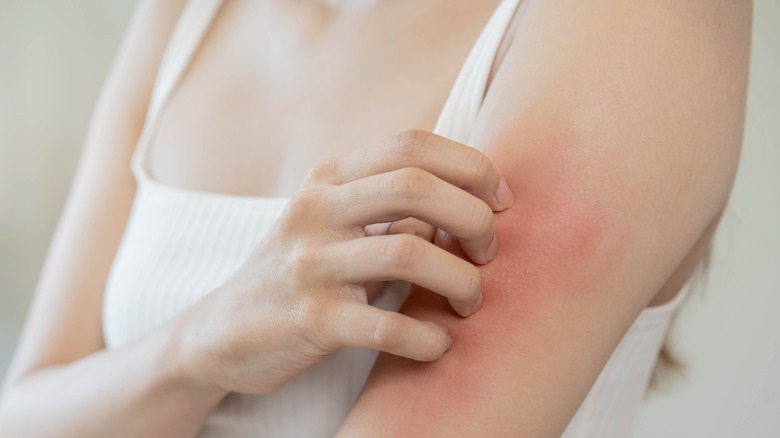 eczema rash on skin