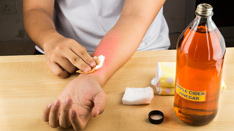 Person applying apple cider vinegar to a sunburn on their forearm
