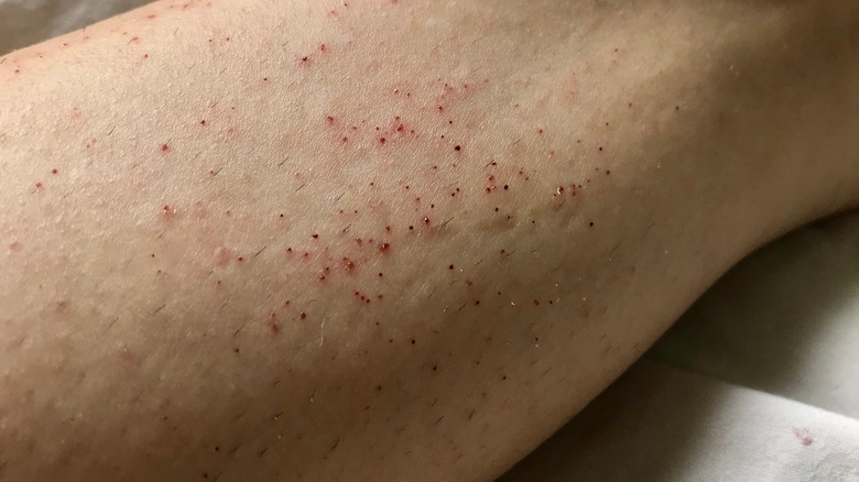 razor burn on skin