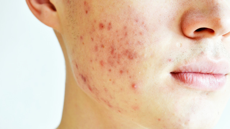  profile of a male with both acne and acne scars 