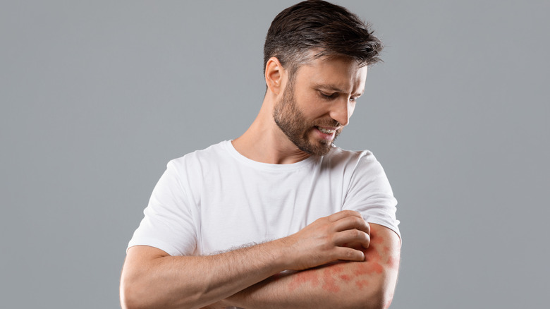 Man scratching rash on arm