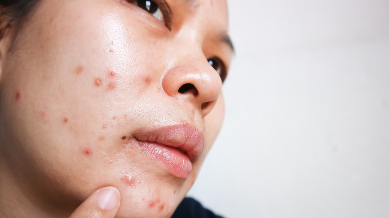 Woman with acne breakout