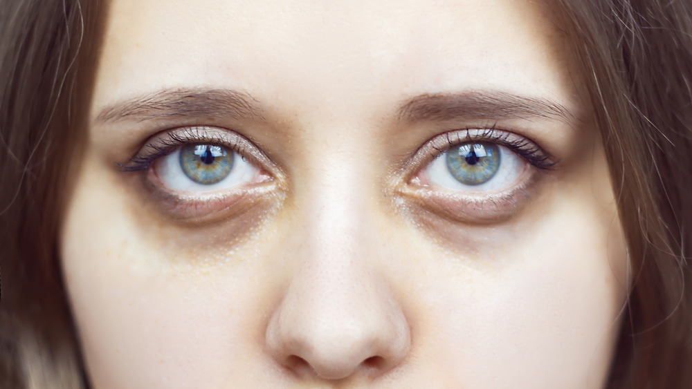 Young woman with dark circles under her eyes