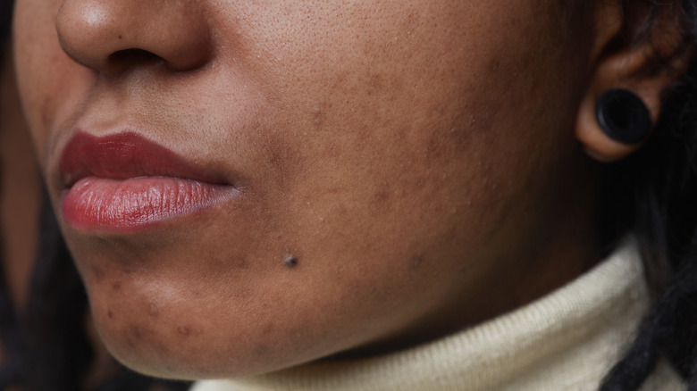 Black woman's chin with acne