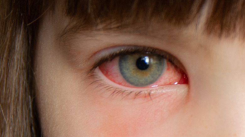 close-up of pink eye in girl's right eye