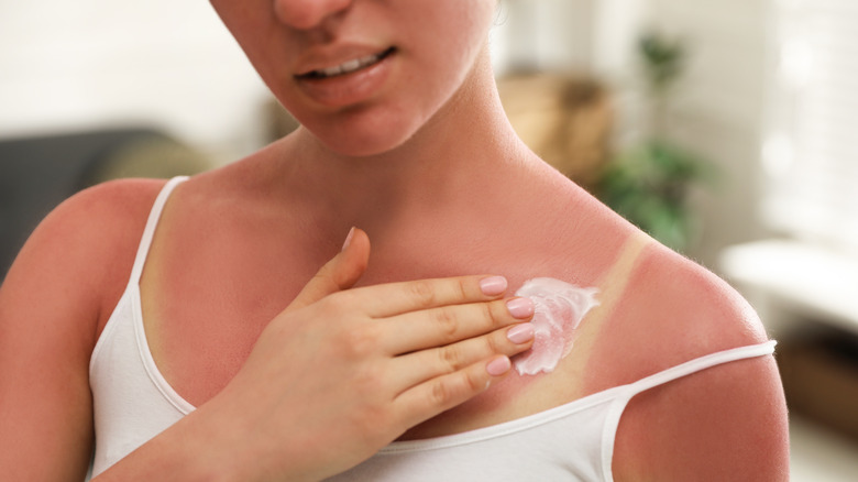woman applying cream to her sunburned skin