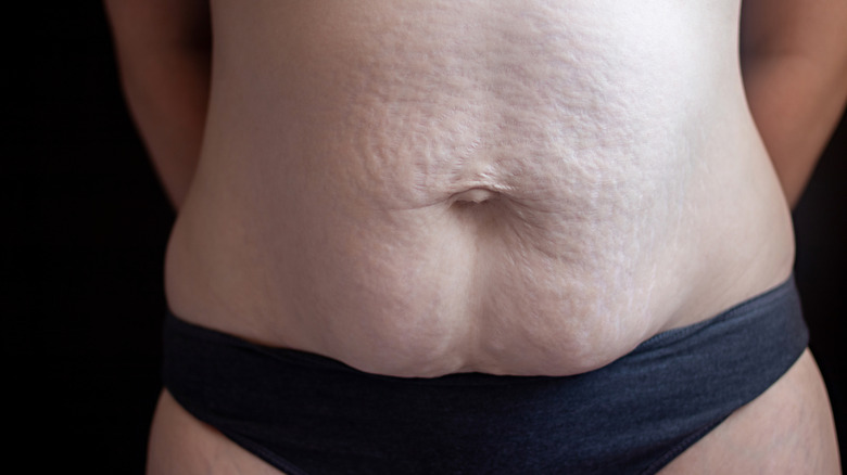 Closeup of a person's abdomen with stretch marks and a noticeable separation of muscles in the middle 