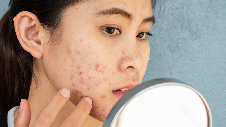 young woman examining her acne in a mirror 