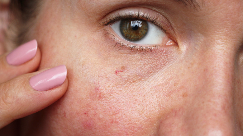 burst blood vessels on woman's face