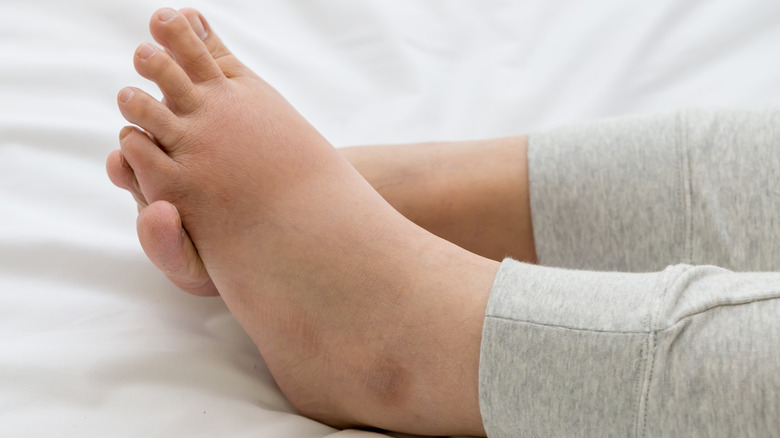 Pregnant woman's swollen feet