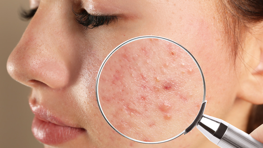 woman's face with acne 
