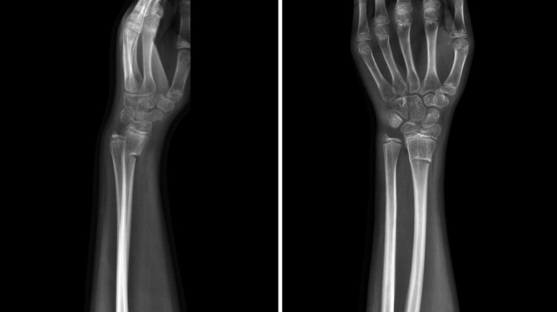Two x-rays side by side of a hand and wrist showing broken wrist bone